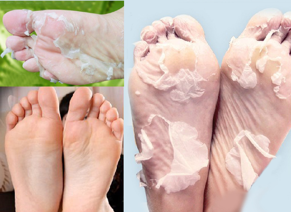 إزالة جلد الأقدام الميت