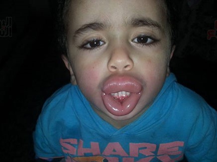 تورم وجه طفل في كفر الشيخ بعد تناوله الشيبسي
