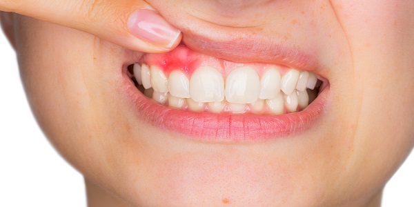 وصفة طبيعية لعلاج خراج الأسنان