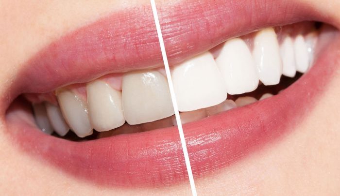وصفات طبيعية لتبييض الاسنان