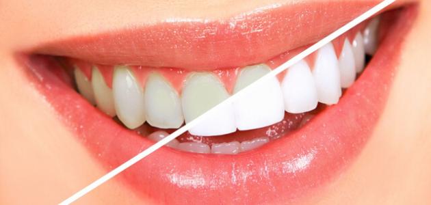 دراسة أمريكية تحذر من تبييض الأسنان