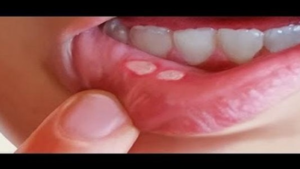 مضاد حيوي لفطريات الفم