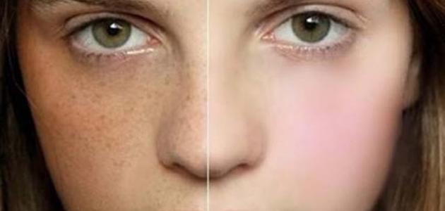 وصفة مجربة لازالة الكلف والبقع البنية من الوجه